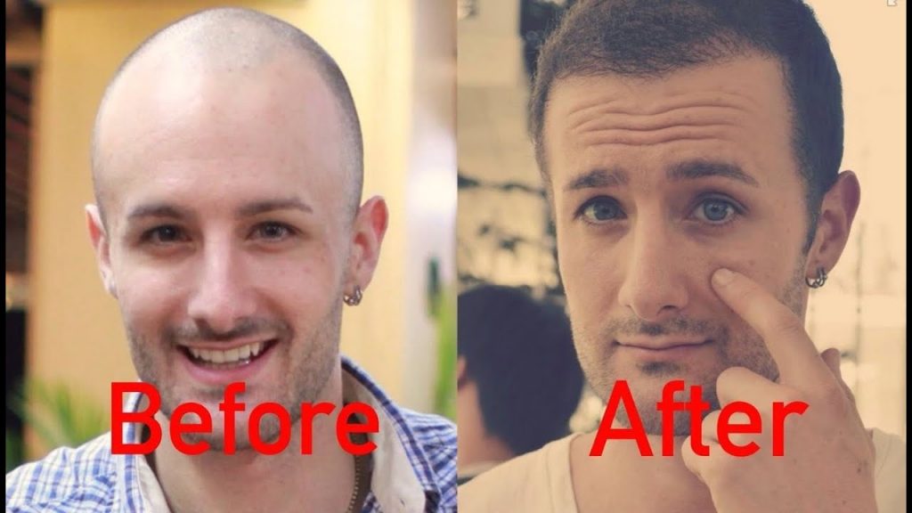 Are you in need of the hair transplant center in Ludhiana?