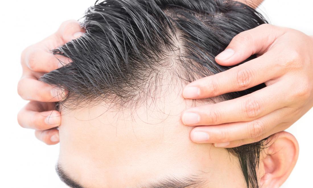 Causes of Male Baldness