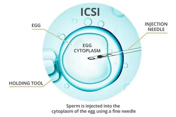 IVF Treatment