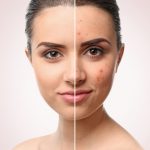 Regular Acne Facials